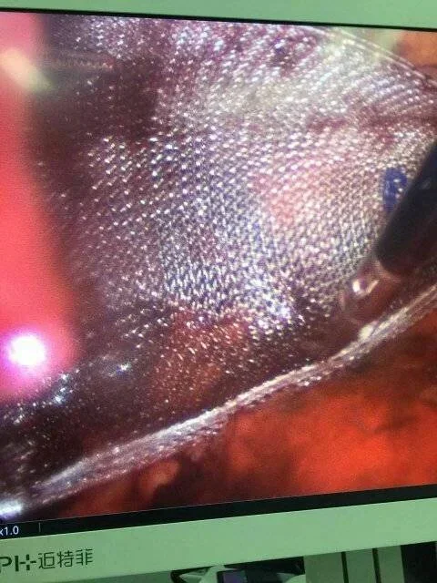 我院胸外科成功完成一例腹腔镜全腹膜外左腹股沟斜疝无张力修补术.webp