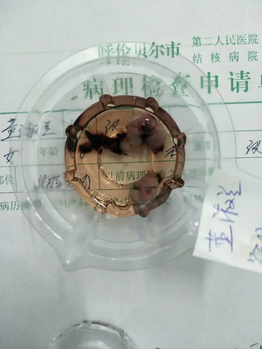 我院腔镜室成功完成一例巨大肠息肉切除病例.webp