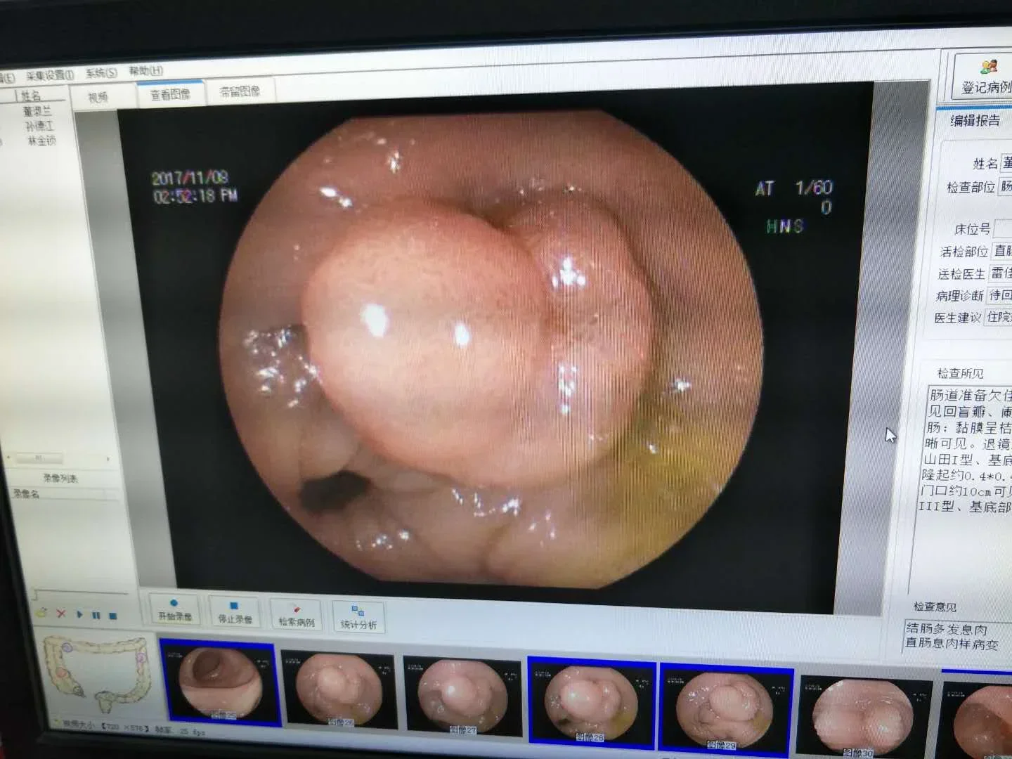 我院腔镜室成功完成一例巨大肠息肉切除病例.webp